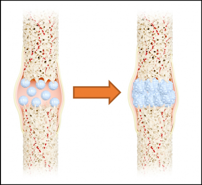 The 'nano-artificial bone material', which closely resembles human bone, exhibits exceptional elasticity, toughness and strength. It can provide stability and promote bone healing.
 